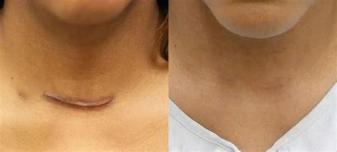 Keloid & Scar Revision Before and Afters | Franklin Skin and Laser