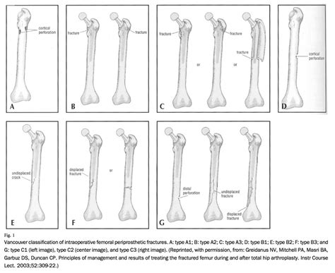 Vancouver Classification & Treatment - Intraoperative Periprosthetic ...