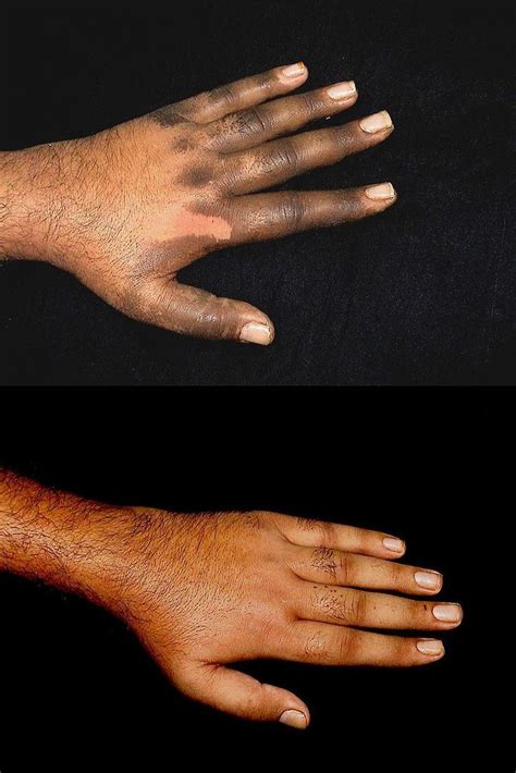 Dermatosis neglecta - Alchetron, The Free Social Encyclopedia