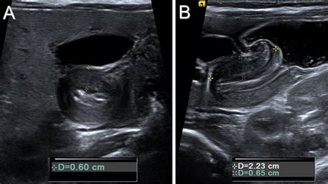 Pyloric Stenosis