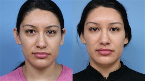 Facial Fillers Before and After Photo Gallery | Palo Alto & San Jose ...