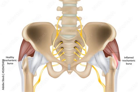 Hip Trochanteric bursitis is inflammation of the bursa. Illustration of the Healthy and inflamed ...