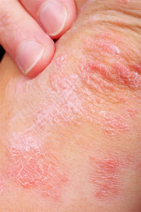 Types Of Skin Diseases – Answers To All Types Of Questions | TypesOf.com