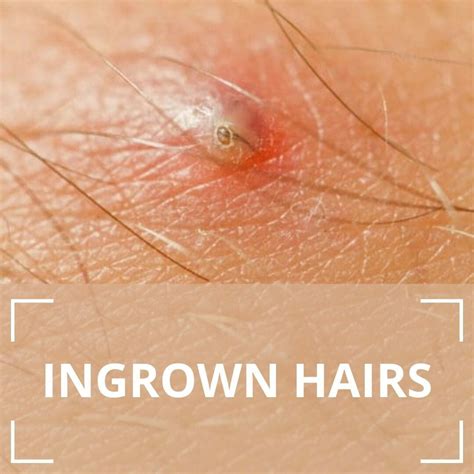 Ingrown Hairs – London Premier Laser & Skin Clinic