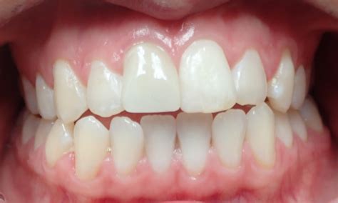 Lake Forest Oral Surgery's Smile Gallery | Dental Trauma Treatment