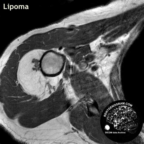 dicom_shoulder_tumor