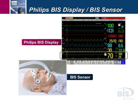 Sedation BIS monitorage