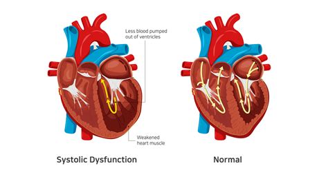 What ar Systolic Heart Failure Symptoms and Treatment | Dr. Raghu