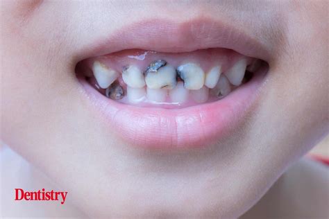 One in 10 three-year-olds already suffer from tooth decay - Dentistry
