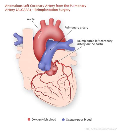 Anomalous Left Coronary Artery From the Pulmonary Artery | Children's ...