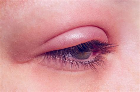 Blepharitis as related to Stye - Pictures