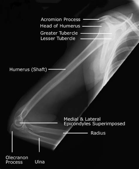 Medical and Health Science: Humerus Lateral!!