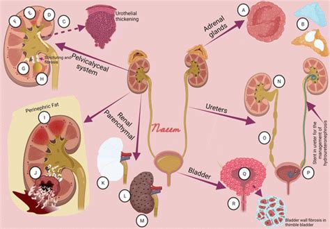 Imaging Manifestations of Genitourinary Tuberculosis | RadioGraphics