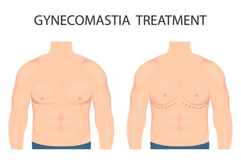 Expert Gynecomastia Treatment At Meadows Wellness