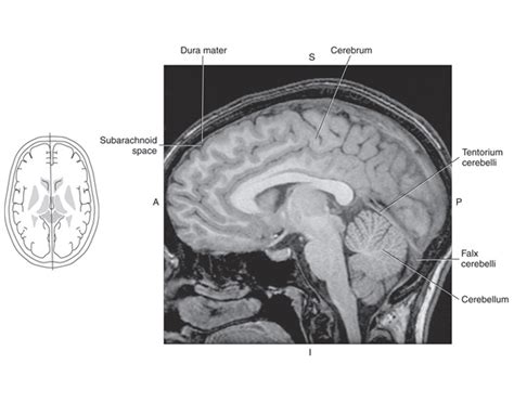 SAGITTAL MRI – FALX CEREBELLI & TENTORIUM CEREBELL Quiz