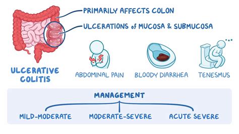 Inflammatory bowel disease (ulcerative colitis): Clinical sciences - Osmosis Video Library