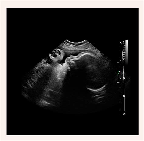 37 Week Ultrasound - Ultrasounds