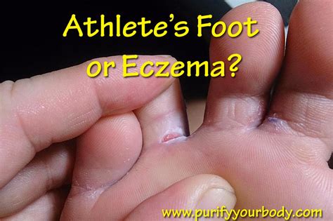 Eczema Toenails Pictures - Nail Ftempo