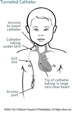 Tunneled Catheter Placement #radiology, #tunneled #central #line, #tunneled #catheter #placement ...