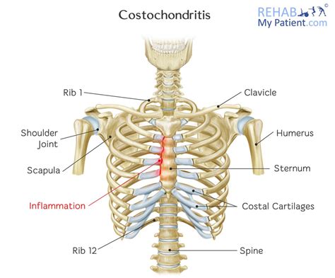 Costochondritis