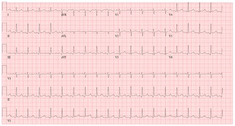 Acute Pericarditis with Tamponade | Patient Case Quiz - American College of Cardiology