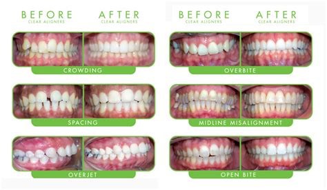 Invisible Braces Cost in Ahmedabad India| Lowcost Clear Invisalign aligner