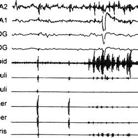 Excessive fragmentary myoclonus is seen on this 60-s epoch of N2 sleep ...