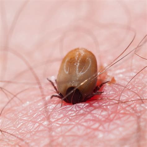 Here’s What a Tick Bite Actually Looks Like | Tick bite, Tick bites pictures, Tick bite symptoms