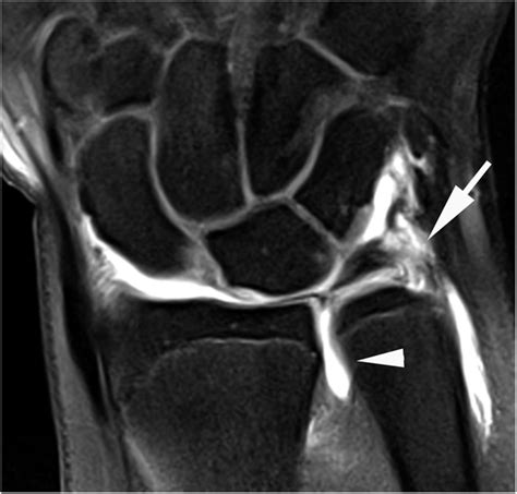 Ulnar Collateral Ligament Wrist Mri