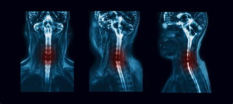 Cervical Facet Syndrome (Arthritis of the neck) - Plainsboro Township, NJ & Freehold, NJ ...