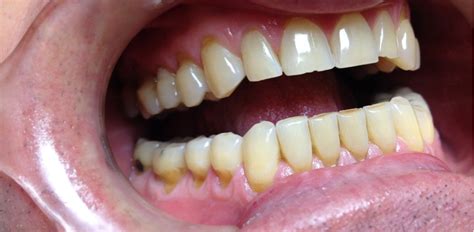 Tooth Abrasion: Causes, Signs and Prevention. – Beyond Smile 247