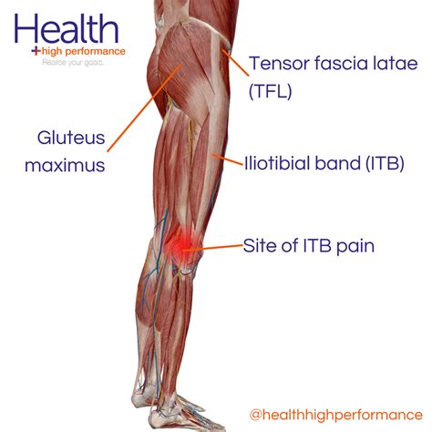 What is ITB syndrome?