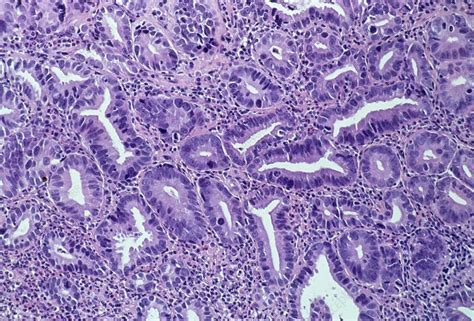 Light micrograph of adenocarcinoma of stomach - Stock Image - M132/0446 - Science Photo Library