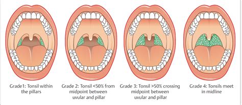 Tonsils and Adenoids | Ento Key