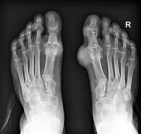 Gout Xray