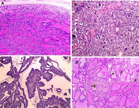 Capsulated follicular neoplasm (A) with areas of questionable nuclear... | Download Scientific ...