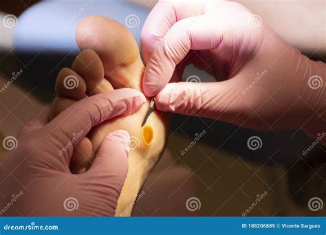 Treatment of a Callus on the Foot Stock Image - Image of pink ...