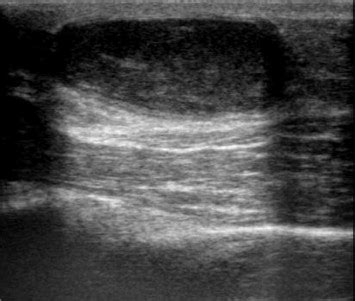 Epidermoid cyst at the dorsum of the lateral elbow. Longitudinal... | Download Scientific Diagram