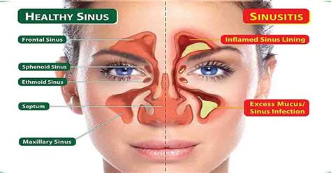 How to Clear Seriously Blocked Sinuses Naturally in 1 Minute | Alternative | Before It's News