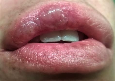 Help! huge blisters on lip!