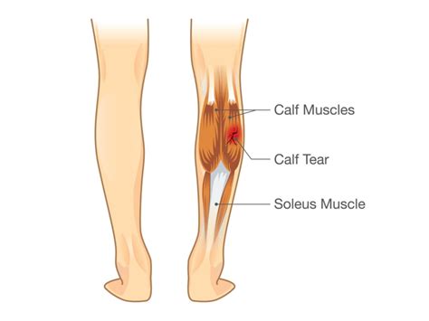 Calf Strain – Dynamic Physio