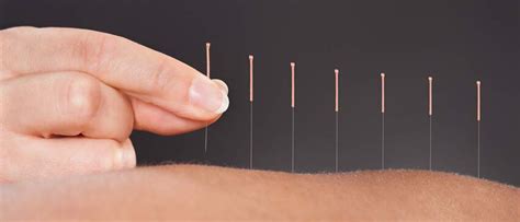 Does Acupuncture Hurt?: All you need to know | Super Health Chatswood Medical Centre