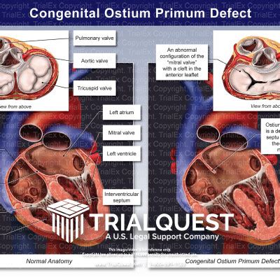 Medical Legal Exhibits - Legal Animations & Trial Graphics - Tria...