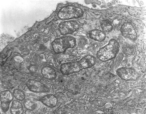 Scrub Typhus; Tsutsugamushi Disease; Typhus, Scrub