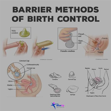 Barrier Methods of Contraception | Viquepedia