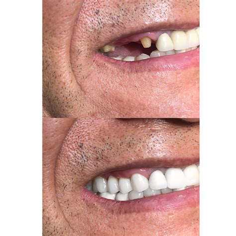 Before & After Dentistry Photos | Give Dental Encino