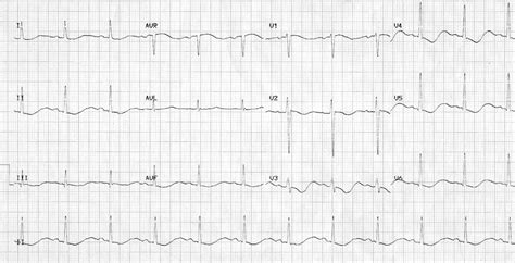 084 - Prolonged QT syndrome and Torsade de pointes with Graeme ...