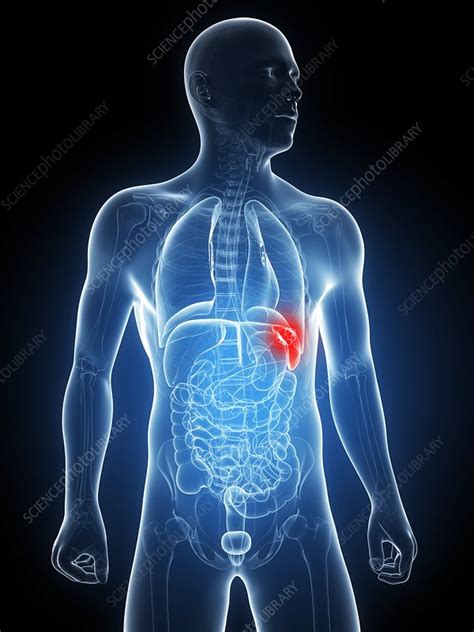 Spleen cancer, artwork - Stock Image - F006/8316 - Science Photo Library