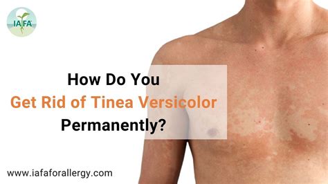 How Do You Get Rid of Tinea Versicolor Permanently?