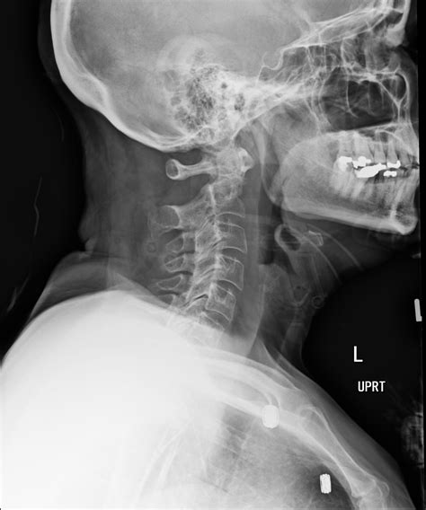 Cervical Spine Imaging in Trauma | CDEM Curriculum